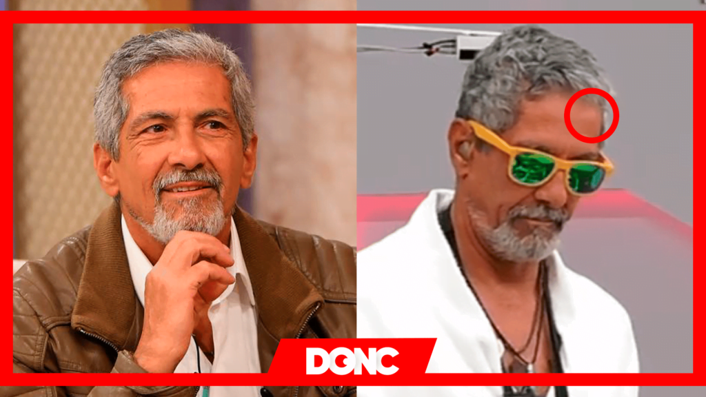 71 nuno homem de sa hematoma